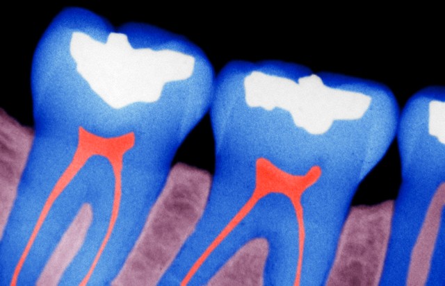 X-ray of dental fillings. Tooth decay or dental caries are popularly called cavities. --- Image by © Dr. John D. Cunningham/Visuals Unlimited/Corbis